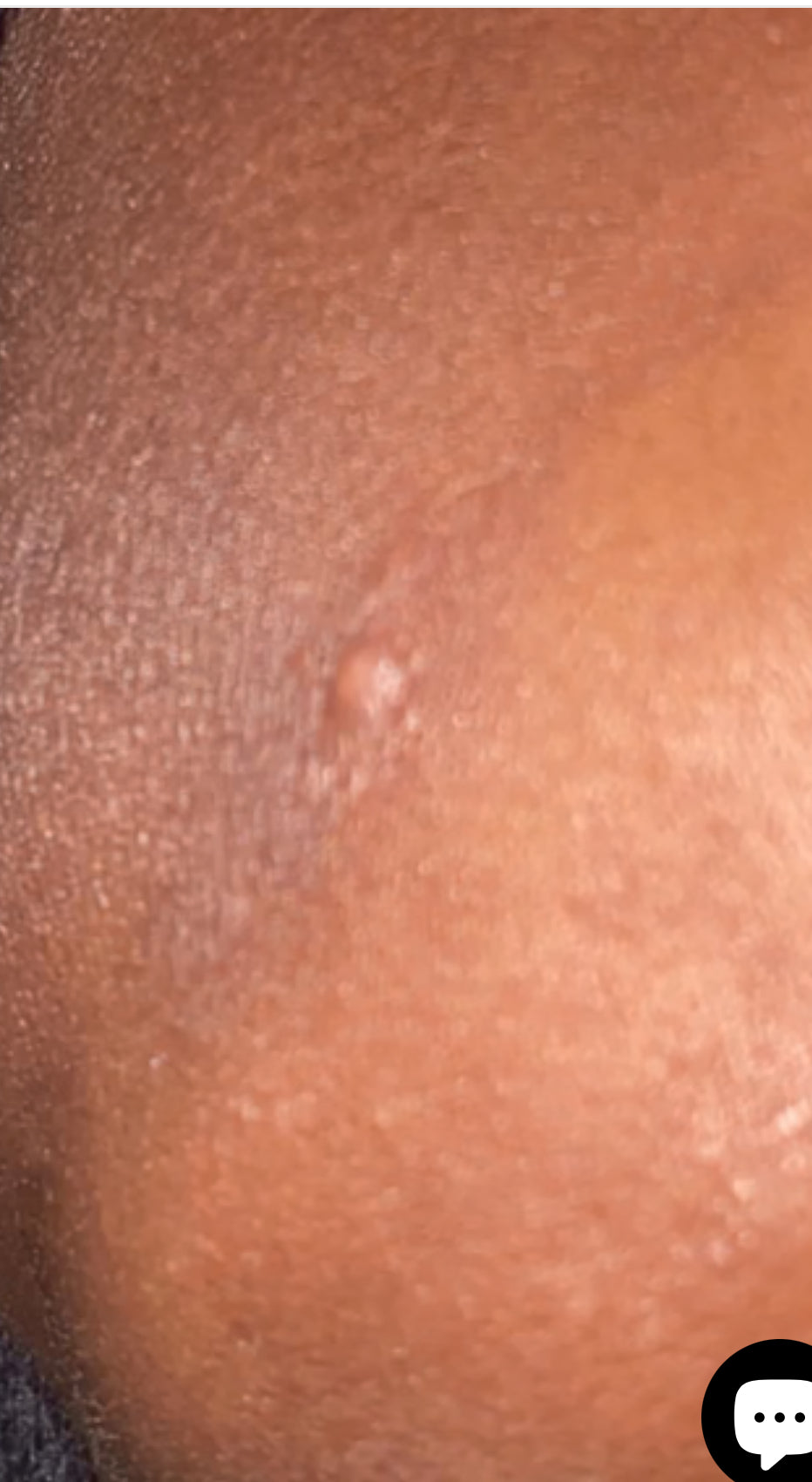 (Herpes) HSV1-2 / HPV / AIDS / SYPHILIS- Natural Herbs