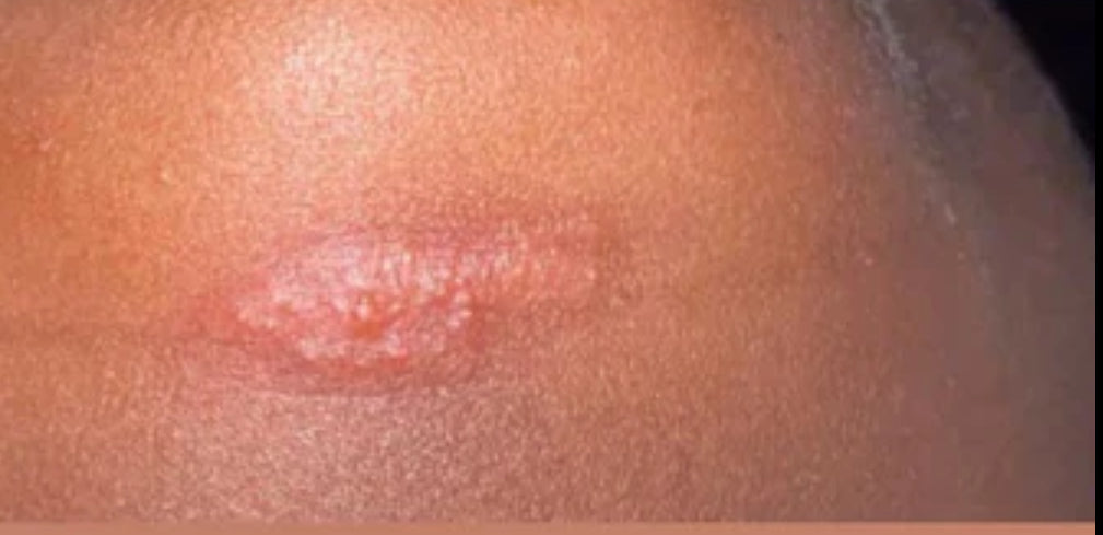 (Herpes) HSV1-2 / HPV / AIDS / SYPHILIS- Natural Herbs