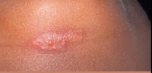 (Herpes) HSV1-2 / HPV / AIDS / SYPHILIS- Natural Herbs